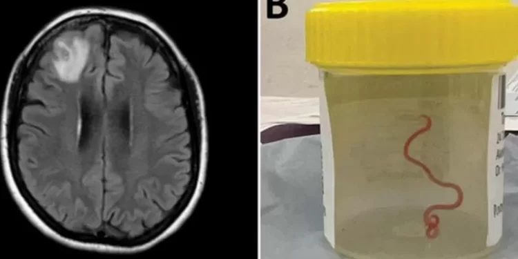 Doctors Remove Live Worm in Woman’s Brain in Australia | METROWATCH